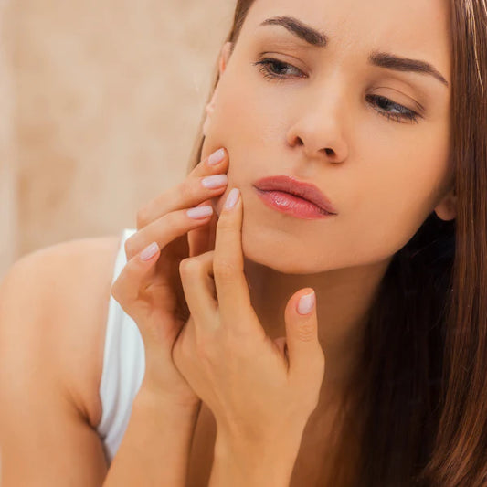 Got Acne Even In Your 20s? Here's Everything You Need To Know About Adult Acne